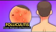 Folliculitis, Causes, Signs and Symptoms, Diagnosis and Treatment.