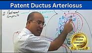 Patent Ductus Arteriosus | PDA