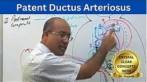 Patent Ductus Arteriosus | PDA