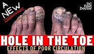 A New Hole In The Toe: Fungal Toenails, Calluses, and Underlying Ulcers