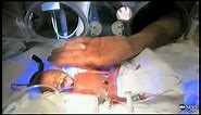 Baby Melinda Video Inspires: Miracle Premature Baby, Size of Human Fist, to Go Home