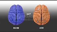 Compare normal vs ADHD brain