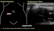 How To Scan Appendix | Ultrasound Probe Positioning | Transducer Placement | Abdominal USG Scanning