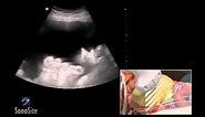 How To: Ultrasound Guided Paracentesis Procedure 3D Video