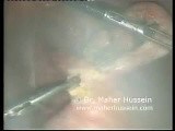 Appendectomy - Laparoscopic Approach • Video • MEDtube.net