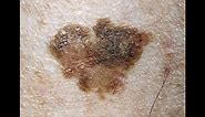Squamous Cell Carcinoma, Actinic Keratosis, and Seborrheic Keratosis: a Dermatology Lecture