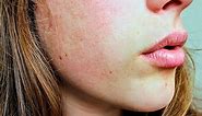 Types of Skin Problems on Face - Top 10 List - Skin Care Geeks