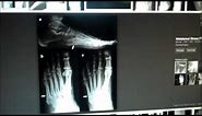 Fracture of the Fifth Metatarsal