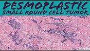 Desmoplastic Small Round Cell Tumor: 5-Minute Pathology Pearls