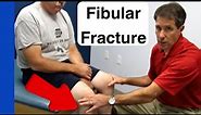 Proximal Fibular Fracture (clinical exam)