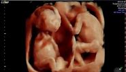 15 week twins 3d4d ultrasound with HDLive at GoldenView Ultrasound
