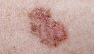 How to spot signs of skin cancer