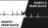 Mobitz Type I vs Type II Second Degree Heart Block
