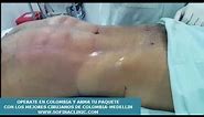 Cirugia plastica Colombia Medellin - sofina clinic