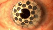 Trypophobia Eye! (Keratoprosthesis)