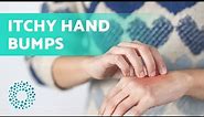 ITCHY BUMPS on the BACK of HANDS (9 Causes) 👋 (Itchy Hands with Pimples)