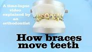 How braces move teeth (time-lapse) - Braces Explained!