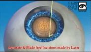 Blade-Free Femto Laser Robotic Cataract Eye Surgery in Delhi - Sharp Sight