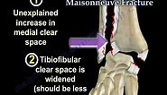 Ankle Fracture Maisonneuve Fracture - Everything You Need To Know - Dr. Nabil Ebraheim