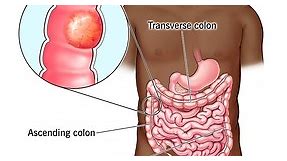 Colon Cancer (Colorectal Cancer)