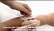How to Use Disposable Medical Zip Wound Closure Device Without Stitches