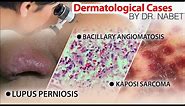 Bacillary angiomatosis - Kaposi sarcoma - Lupus perniosis