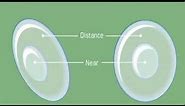 How Do Bifocal Soft Contact Lenses Work?