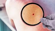 What Are Red Moles? Understanding Cherry Angiomas