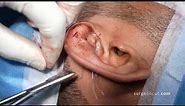 Ear Pinning Surgery - Surgery to Reduce Bat Ears