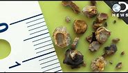 Everything You Need To Know About Kidney Stones