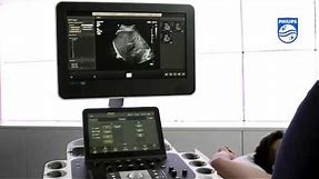 How To Use shear wave Elastography on a Philips EPIQ Ultrasound System