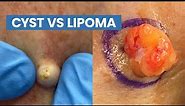 Cyst vs Lipoma (Short Pops Compilation) | CONTOUR DERMATOLOGY