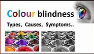 Colour blindness | Types, Causes, Symptoms, Treatment