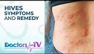 Hives Symptoms and Remedy | DOTV