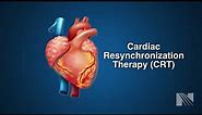 Ventricular Fibrillation Treatment: Cardiac Resyncrhoniation Therapy (CRT)