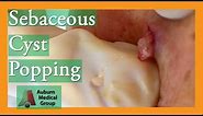 Epidermoid Cyst Popping #popping | Auburn Medical Group