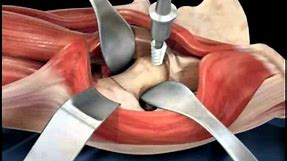Hip replacement surgery techniques - Dr. Scott Devinney
