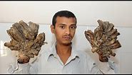 Surgeries Give “Tree Man” His Life Back