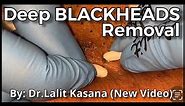 Deep Old Blackhead Removal with Cotton Buds & Extractor by Dr.Lalit Kasana