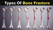 Common types of Bone fracture | 3D animation |