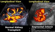 Renal Transplant Doppler Ultrasound Normal Vs Abnormal Images | Transplant Complication | Kidney USG