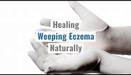 Tips for Weeping Eczema Naturally - Treating Eczema Naturally