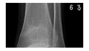 Stress fracture | Radiology Reference Article | Radiopaedia.org