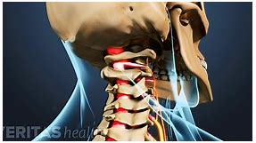 How Cervical Radiculopathy Causes Pain, Numbness, and Weakness