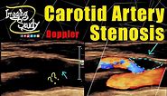 Carotid Artery Stenosis || Ultrasound || Doppler || Case 246