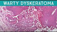 Warty Dyskeratoma (acantholytic dyskeratosis pattern)(dermatology pathology dermatopathology)