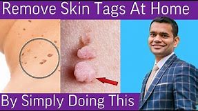 Remove Skin Tags | Home Remedies To Remove Skin Tags | Dr. Vivek Joshi