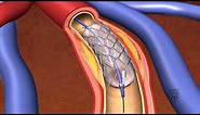 Animation - Coronary stent placement