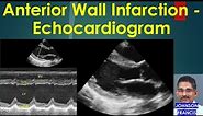 Anterior Wall Infarction Echocardiogram