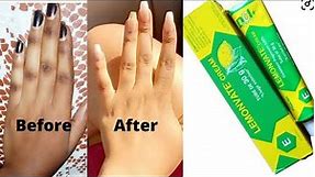 How to get rid of dark knuckle with lemonvate cream in one night